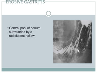 EROSIVE GASTRITIS
• Central pool of barium
surrounded by a
radiolucent hallow
 