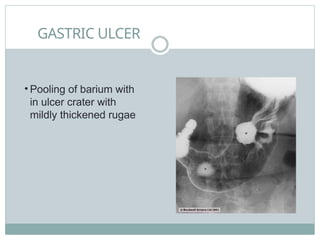 GASTRIC ULCER
• Pooling of barium with
in ulcer crater with
mildly thickened rugae
 