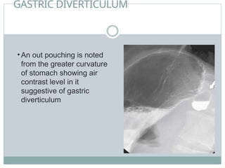 GASTRIC DIVERTICULUM
• An out pouching is noted
from the greater curvature
of stomach showing air
contrast level in it
suggestive of gastric
diverticulum
 