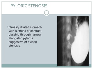 PYLORIC STENOSIS
• Grossly dilated stomach
with a streak of contrast
passing through narrow
elongated pylorus
suggestive of pyloric
stenosis
 