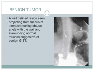 BENIGN TUMOR
• A well defined lesion seen
projecting from fundus of
stomach making obtuse
angle with the wall and
surrounding normal
mucosa suggestive of
benign GIST.
 