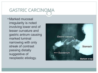 GASTRIC CARCINOMA
• Marked mucosal
irregularity is noted
involving lower end of
lesser curvature and
gastric antrum causing
marked luminal
narrowing with only
streak of contrast
passing distally
suggestive of
neoplastic etiology.
 