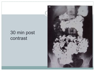 30 min post
contrast
 