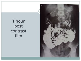 1 hour
post
contrast
film
 