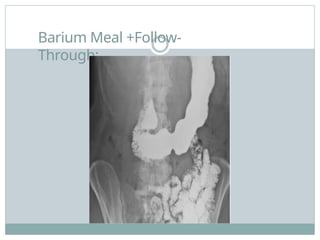 Barium Meal +Follow-
Through:
 