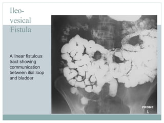 Ileo-
vesical
Fistula
A linear fistulous
tract showing
communication
between ilial loop
and bladder
 