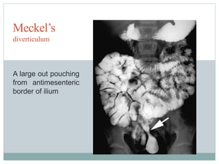 Meckel’s
diverticulum
A large out pouching
from antimesenteric
border of ilium
 