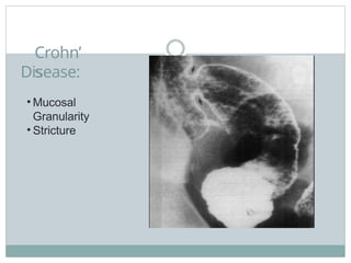 Crohn’
s
Disease:
• Mucosal
Granularity
• Stricture
 