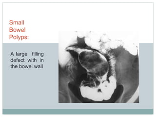 Small
Bowel
Polyps:
A large filling
defect with in
the bowel wall
 