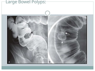 Large Bowel Polyps:
 