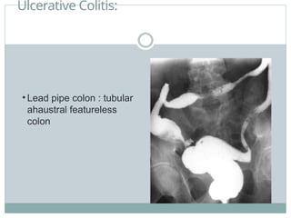 Ulcerative Colitis:
• Lead pipe colon : tubular
ahaustral featureless
colon
 