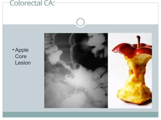 Colorectal CA:
• Apple
Core
Lesion
 