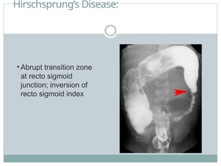 Hirschsprung’s Disease:
• Abrupt transition zone
at recto sigmoid
junction; inversion of
recto sigmoid index
 