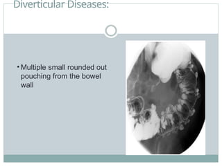 Diverticular Diseases:
• Multiple small rounded out
pouching from the bowel
wall
 