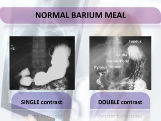 NORMAL BARIUM MEAL
SINGLE contrast DOUBLE contrast
 