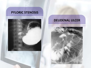 PYLORIC STENOSIS
DEUDENAL ULCER
 