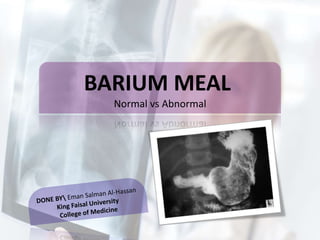 BARIUM MEAL
Normal vs Abnormal
 