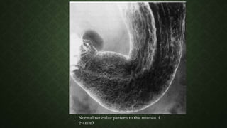 Normal reticular pattern to the mucosa. (
2-4mm)
 