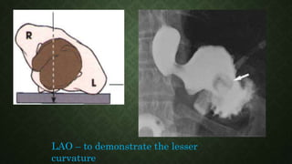 LAO – to demonstrate the lesser
curvature
 