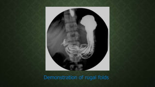Demonstration of rugal folds
 