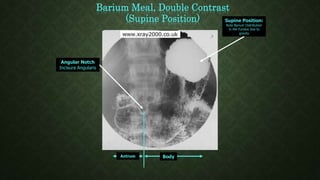 Angular Notch
Incisura Angularis
Barium Meal, Double Contrast
(Supine Position)
BodyAntrum
Supine Position:
Note Barium Distribution
in the Fundus due to
gravity
 