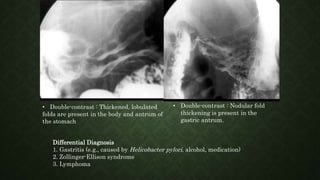 • Double-contrast : Thickened, lobulated
folds are present in the body and antrum of
the stomach
• Double-contrast : Nodular fold
thickening is present in the
gastric antrum.
Differential Diagnosis
1. Gastritis (e.g., caused by Helicobacter pylori, alcohol, medication)
2. Zollinger-Ellison syndrome
3. Lymphoma
 