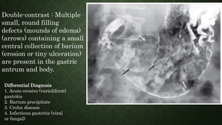 Double-contrast : Multiple
small, round filling
defects (mounds of edema)
(arrows) containing a small
central collection of barium
(erosion or tiny ulceration)
are present in the gastric
antrum and body.
Differential Diagnosis
1. Acute erosive (varioliform)
gastritis
2. Barium precipitate
3. Crohn disease
4. Infectious gastritis (viral
or fungal)
 