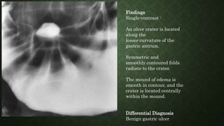 Findings
Single-contrast :
An ulcer crater is located
along the
lesser curvature of the
gastric antrum.
Symmetric and
smoothly contoured folds
radiate to the crater.
The mound of edema is
smooth in contour, and the
crater is located centrally
within the mound.
Differential Diagnosis
Benign gastric ulcer
 
