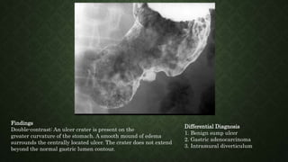 Findings
Double-contrast: An ulcer crater is present on the
greater curvature of the stomach. A smooth mound of edema
surrounds the centrally located ulcer. The crater does not extend
beyond the normal gastric lumen contour.
Differential Diagnosis
1. Benign sump ulcer
2. Gastric adenocarcinoma
3. Intramural diverticulum
 