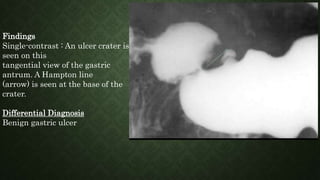 Findings
Single-contrast : An ulcer crater is
seen on this
tangential view of the gastric
antrum. A Hampton line
(arrow) is seen at the base of the
crater.
Differential Diagnosis
Benign gastric ulcer
 