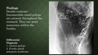 Findings
Double-contrast :
Innumerable small polyps
are present throughout the
stomach. They are most
numerous within the
fundus.
Differential
Diagnosis
1. Gastric polyps
2. Fundic gland
polyposis syndrome
 