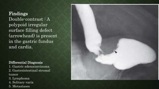 Findings
Double-contrast : A
polypoid irregular
surface filling defect
(arrowhead) is present
in the gastric fundus
and cardia.
Differential Diagnosis
1. Gastric adenocarcinoma
2. Gastrointestinal stromal
tumor
3. Lymphoma
4. Solitary varix
5. Metastases
 
