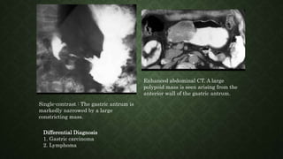 Single-contrast : The gastric antrum is
markedly narrowed by a large
constricting mass.
Enhanced abdominal CT. A large
polypoid mass is seen arising from the
anterior wall of the gastric antrum.
Differential Diagnosis
1. Gastric carcinoma
2. Lymphoma
 