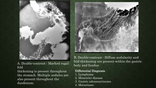 A. Double-contrast : Marked rugal
fold
thickening is present throughout
the stomach. Multiple nodules are
also present throughout the
duodenum.
B. Double-contrast : Diffuse nodularity and
fold thickening are present within the gastric
body and fundus.
Differential Diagnosis
1. Lymphoma
2. Menetrier disease
3. Gastric adenocarcinoma
4. Metastases
 