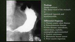 Findings
Single-contrast :
The distal third of the stomach
is
narrowed, tapered, and
nondistensible.
Differential Diagnosis
1. Chronic peptic ulcer disease
2. Granulomatous disease
(Crohn disease, sarcoidosis,
tuberculosis, syphilis,
eosinophilic gastroenteritis)
3. Gastric carcinoma
4. Metastatic breast cancer
5. Prior caustic ingestion
 