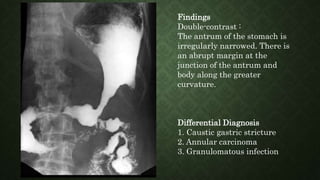 Findings
Double-contrast :
The antrum of the stomach is
irregularly narrowed. There is
an abrupt margin at the
junction of the antrum and
body along the greater
curvature.
Differential Diagnosis
1. Caustic gastric stricture
2. Annular carcinoma
3. Granulomatous infection
 