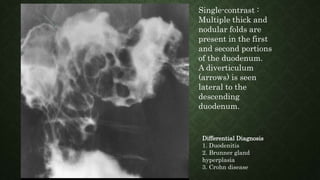 Single-contrast :
Multiple thick and
nodular folds are
present in the first
and second portions
of the duodenum.
A diverticulum
(arrows) is seen
lateral to the
descending
duodenum.
Differential Diagnosis
1. Duodenitis
2. Brunner gland
hyperplasia
3. Crohn disease
 