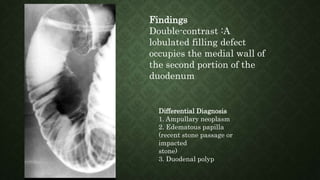 Findings
Double-contrast :A
lobulated filling defect
occupies the medial wall of
the second portion of the
duodenum
Differential Diagnosis
1. Ampullary neoplasm
2. Edematous papilla
(recent stone passage or
impacted
stone)
3. Duodenal polyp
 