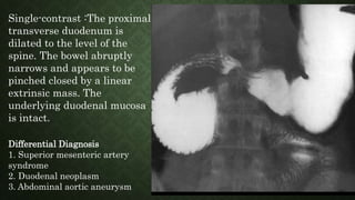 Single-contrast :The proximal
transverse duodenum is
dilated to the level of the
spine. The bowel abruptly
narrows and appears to be
pinched closed by a linear
extrinsic mass. The
underlying duodenal mucosa
is intact.
Differential Diagnosis
1. Superior mesenteric artery
syndrome
2. Duodenal neoplasm
3. Abdominal aortic aneurysm
 
