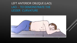 LEFT ANTERIOR OBLIQUE (LAO):
LAO – TO DEMONSTRATE THE
LESSER CURVATURE
 