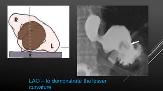 LAO – to demonstrate the lesser
curvature
 