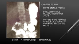Barium –PA stomach, single contrast study
EVALUATION CRITERIA:
• ENTIRE STOMACH VISIBLE.
• BODY AND PYLORUS
FILLED WITH CONTRAST
AGENT.
• SUFFICIENT GAS RETAINED
WITH SUITABLE CONTRAST
COATING TO SEE GASTRIC
MUCOSA.
 