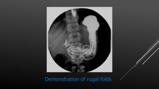 Demonstration of rugal folds
 