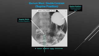 Angular Notch
Incisura Angularis
(Supine Position)
Body
Antrum
Supine Position:
Note Barium Distribution
in the Fundus due to
gravity
Barium Meal, Double Contrast
 