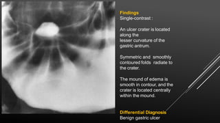 Findings
Single-contrast :
An ulcer crater is located
along the
lesser curvature of the
gastric antrum.
Symmetric and smoothly
contoured folds radiate to
the crater.
The mound of edema is
smooth in contour, and the
crater is located centrally
within the mound.
Differential Diagnosis
Benign gastric ulcer
 