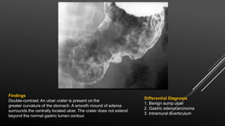 Findings
Double-contrast: An ulcer crater is present on the
greater curvature of the stomach. A smooth mound of edema
surrounds the centrally located ulcer. The crater does not extend
beyond the normal gastric lumen contour.
Differential Diagnosis
1. Benign sump ulcer
2. Gastric adenocarcinoma
3. Intramural diverticulum
 