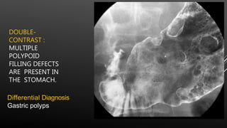DOUBLE-
CONTRAST :
MULTIPLE
POLYPOID
FILLING DEFECTS
ARE PRESENT IN
THE STOMACH.
Differential Diagnosis
Gastric polyps
 
