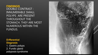 FINDINGS
DOUBLE-CONTRAST :
INNUMERABLE SMALL
POLYPS ARE PRESENT
THROUGHOUT THE
STOMACH. THEY ARE MOST
NUMEROUS WITHIN THE
FUNDUS.
Differential
Diagnosis
1. Gastric polyps
2. Fundic gland
polyposis syndrome
 