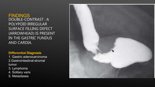 FINDINGS
DOUBLE-CONTRAST : A
POLYPOID IRREGULAR
SURFACE FILLING DEFECT
(ARROWHEAD) IS PRESENT
IN THE GASTRIC FUNDUS
AND CARDIA.
Differential Diagnosis
1. Gastric adenocarcinoma
2.Gastrointestinal stromal
tumor
3. Lymphoma
4. Solitary varix
5. Metastases
 