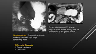 Enhanced abdominal CT. A large
polypoid mass is seen arising from the
anterior wall of the gastric antrum.
Single-contrast : The gastric antrum is
markedly narrowed by a large
constricting mass.
Differential Diagnosis
1. Gastric carcinoma
2. Lymphoma
 
